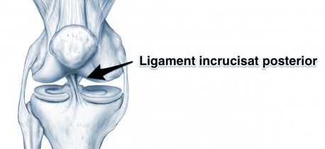 Clasificarea leziunilor ligamentelor genunchiului, Leziunile ligamentului colateral extern (LCL)